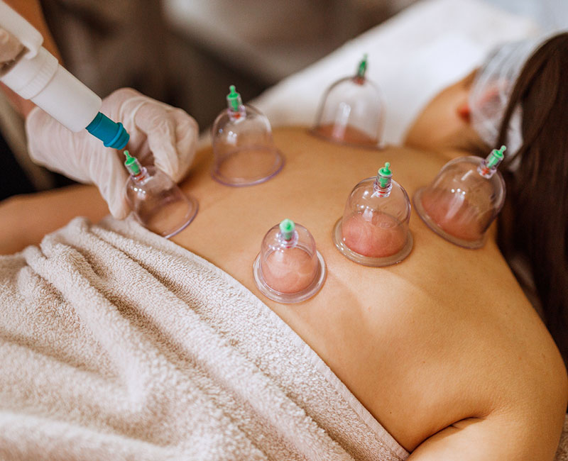 cupping therapy in Abu Dhbai