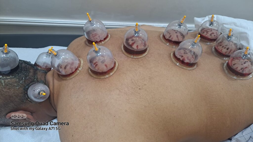 Hijama Service in Abu Dhabi
