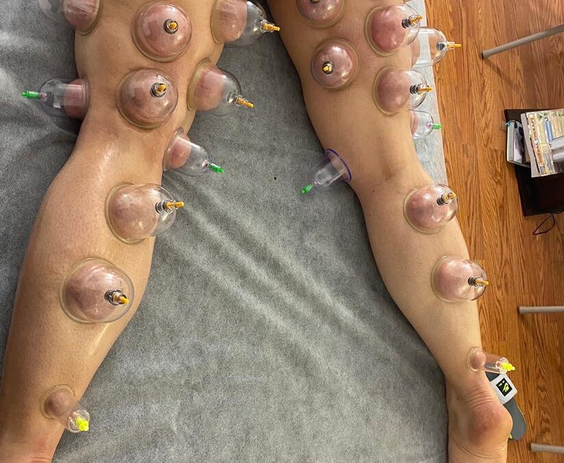 Hijama for leg pain in Abu Dhabi