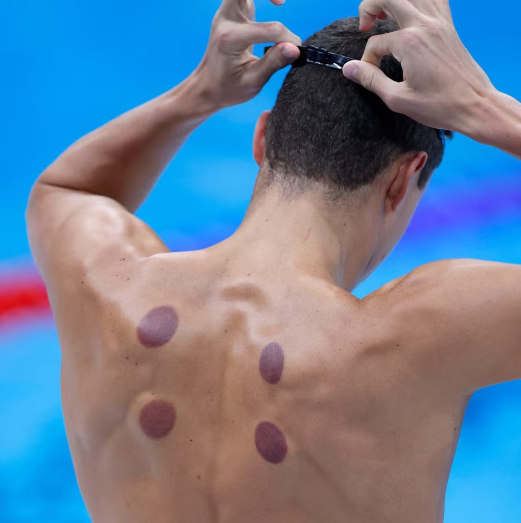 Hijama Benefits for Athletes Abu Dhabi